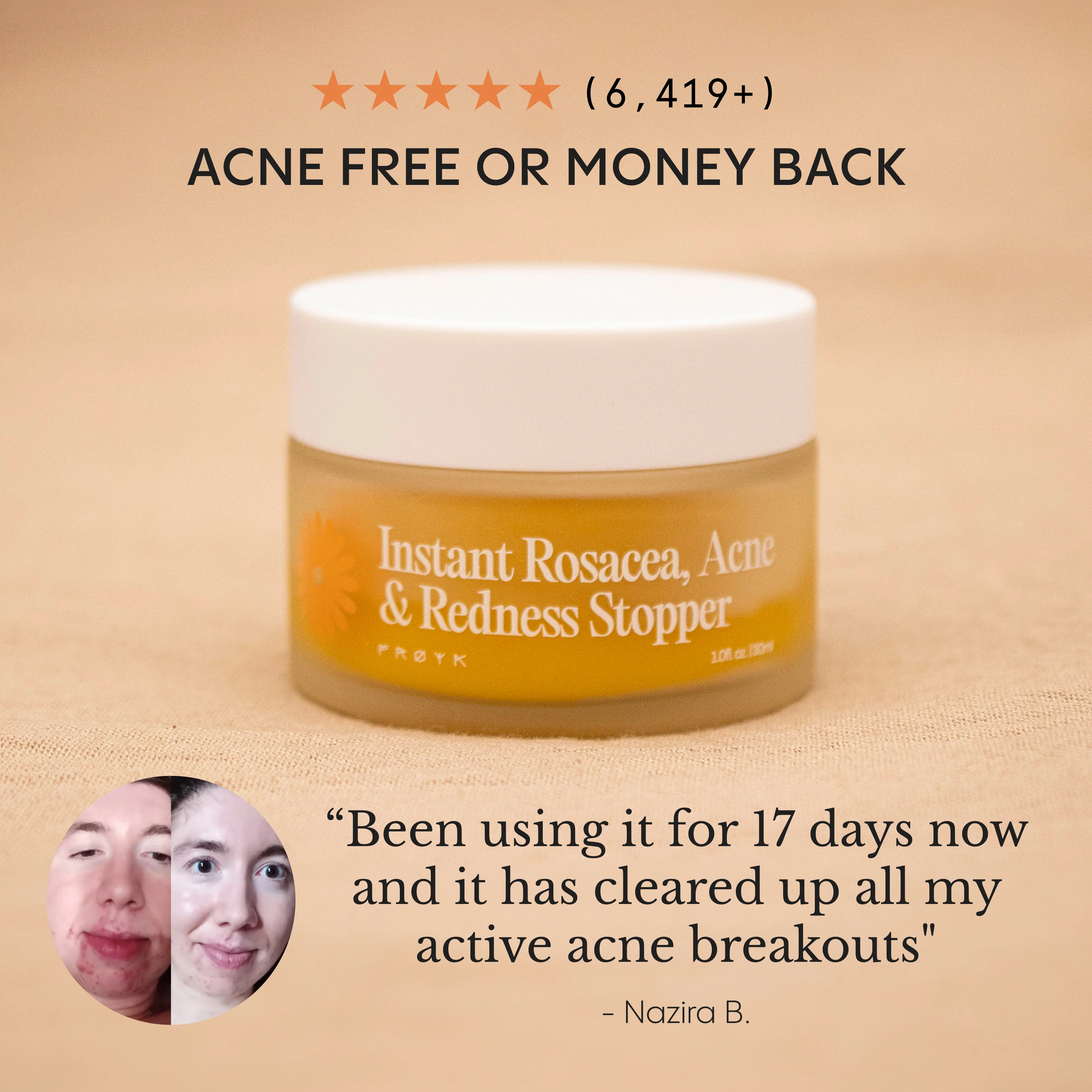 The Complete Acne System for Women - Image 16