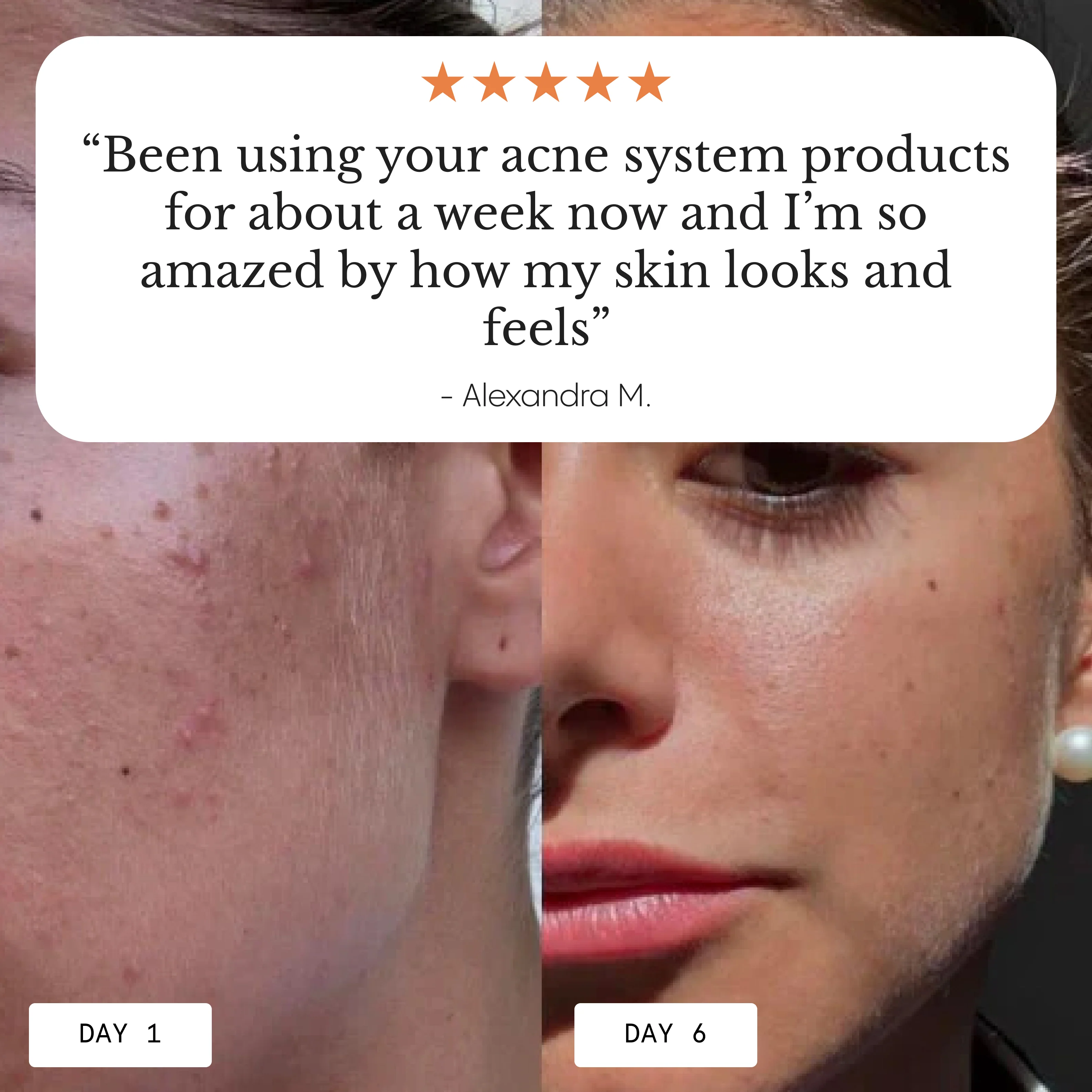 The Complete Acne System for Women - Image 3