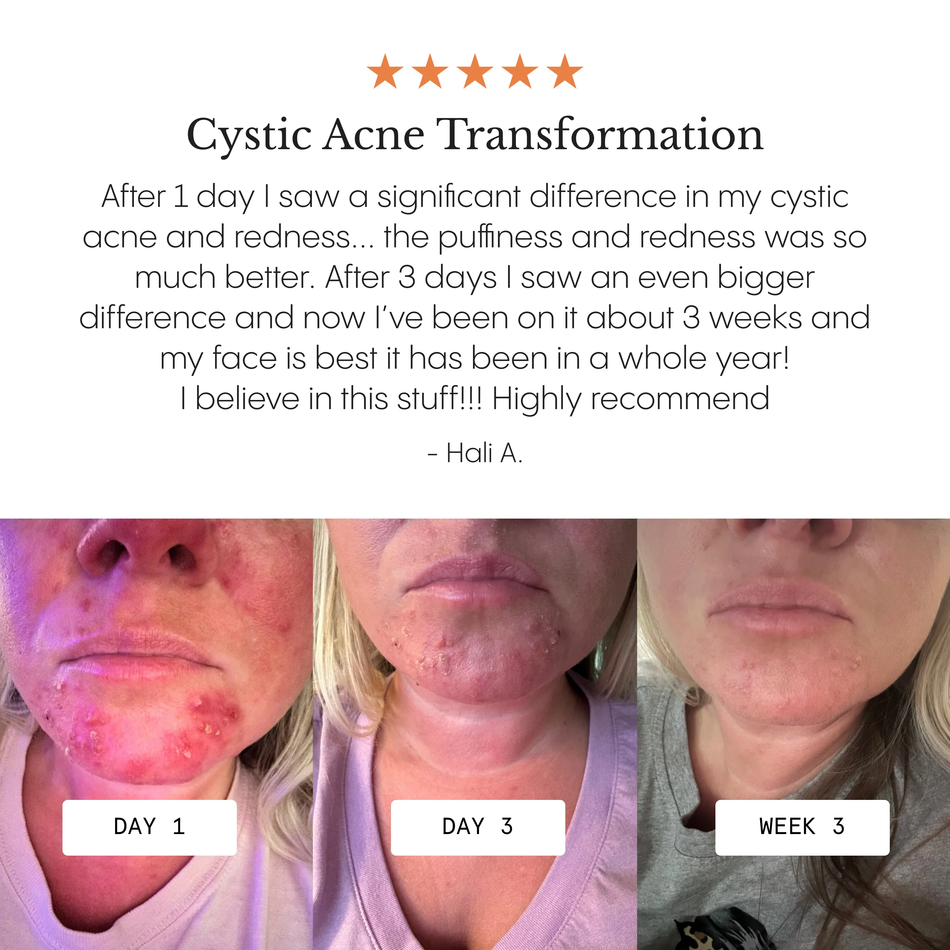 The Complete Acne System for Women - Image 4